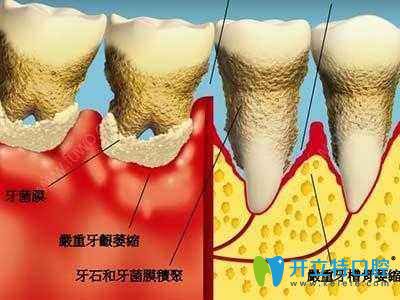 牙齿矫正是否会导致牙龈萎缩