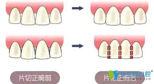 牙齿片切的危害