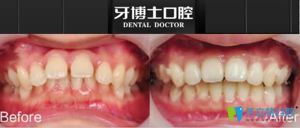 宁波牙博士口腔深覆盖牙齿矫正前后对比照