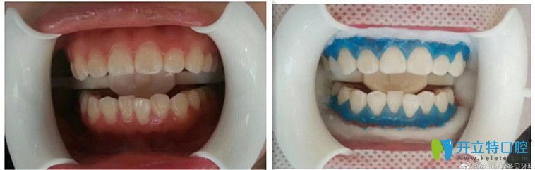 成都圣贝黄祎铭牙齿美白效果图