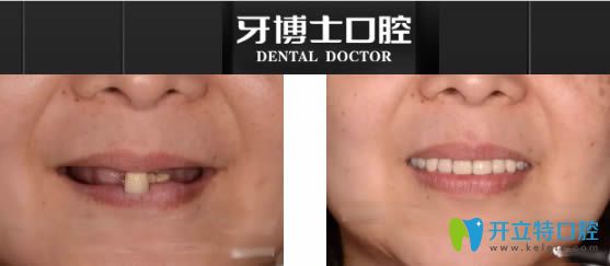 宁波牙博士全口种植牙真实<span style=