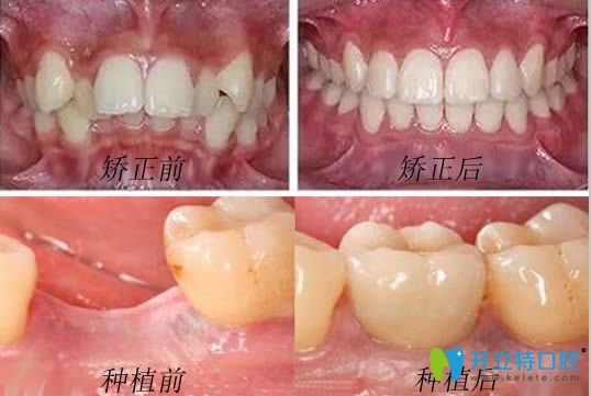 哈尔滨瑞益口腔牙齿正畸和种植牙案例效果对比图