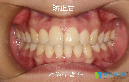 我在南京牙仙子口腔做隐形矫正后牙齿照片