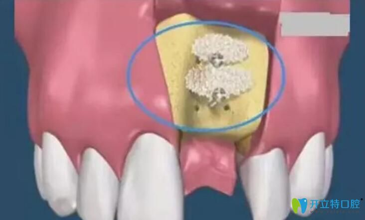 种牙植骨痛苦吗,多久可以消肿?种植牙骨粉0.25g价格是多少?
