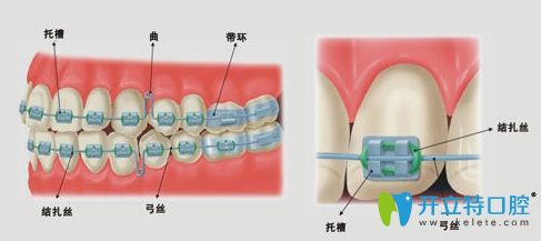 牙齿托槽掉了必须要马上粘接