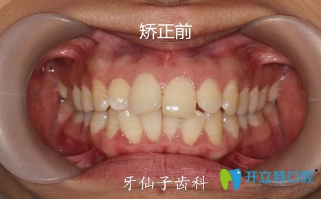 我在南京牙仙子齿科做牙齿矫正前牙齿照片