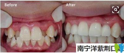 儿童虎牙矫正前后对比效果