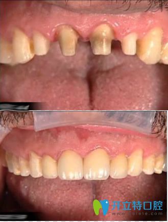54岁张先生做前牙全瓷冠修复前后对比效果