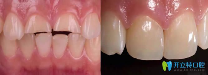 丁蕾医师对外伤前牙树脂贴面修复前后对比效果