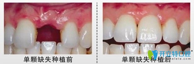 南京牙仙子口腔鲁纯医生单颗种植牙案例