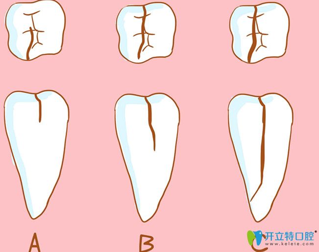 牙齿开裂造成的原因