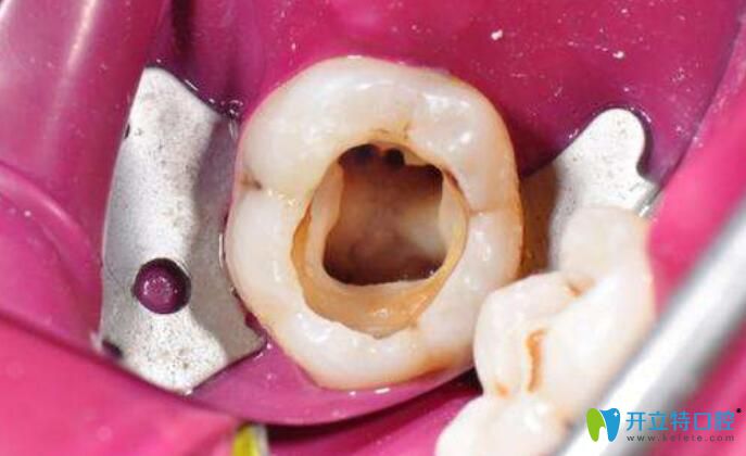 蛀牙肯能导致牙碎裂