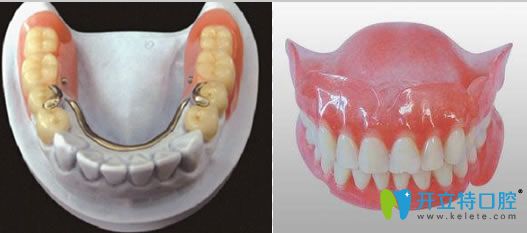 吴医生解析活动假牙和固定假牙哪个好