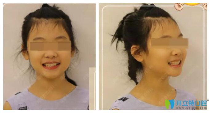 小孩子在成都圣贝口腔矫正后效果图 小孩子在成都圣贝口腔矫正后效果图