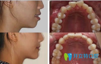武汉清华阳光口腔冮卫东牙齿矫正案例