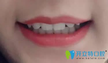 在昆明同仁口腔做牙齿矫正第15个月取牙套