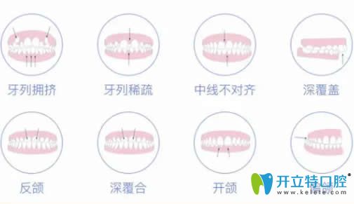 医生解惑牙齿矫正后反弹的原因及矫正后牙齿反弹了怎么办