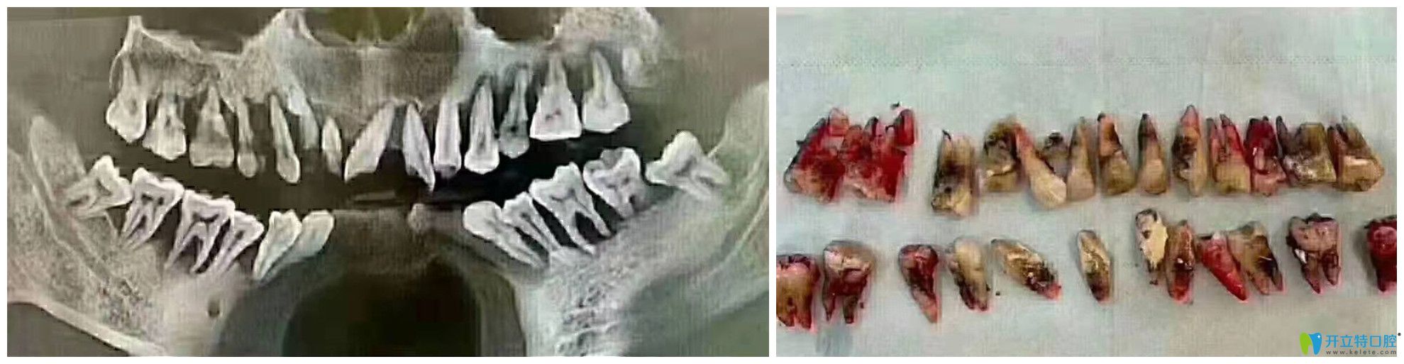 牙齿松动来就诊，结果全部牙齿都保留不了了