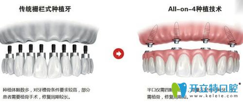 佛山智媄口腔allon4种植牙