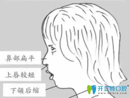 小孩经常用嘴巴呼吸会导致脸型变丑,教你如何纠正口呼吸