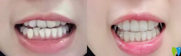 佛山智媄口腔隐形牙齿矫正1年效果