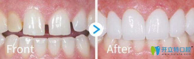 彭学兵瓷贴面修复牙齿案例效果对比图