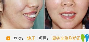 常州北极星口腔龅牙矫正案例