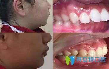 上海恒佳齿科李健儿童牙齿矫正案例