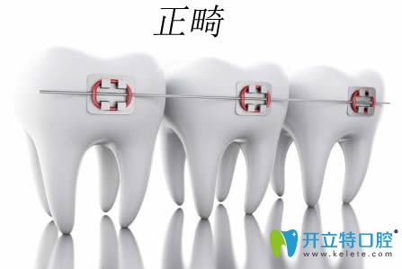 给想在广州做正畸的朋友罗列了10条牙齿矫正需要注意的问题