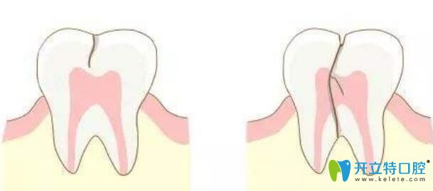 牙齿劈裂能自愈吗？