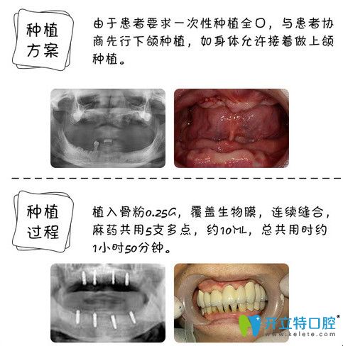 东莞好百年口腔怎么样？60岁老人全口牙种植案例见证