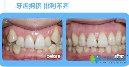 深圳诺德文梁医生牙齿拥挤矫正前后对比效果 深圳诺德文梁医生牙齿拥挤矫正前后对比效果