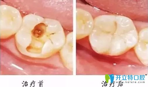 磨牙龋坏补牙前后对比图