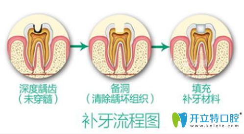 补牙流程图