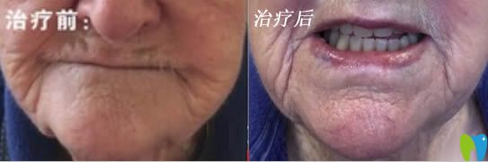 西安高陵康洁口腔李征活动义齿修复案例图