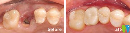 众牙口腔种植牙前后对比图