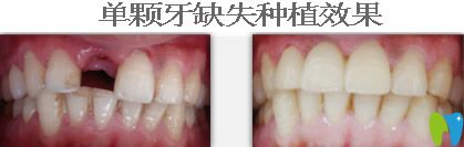 上海恒佳齿科李勇医生单颗种植牙案例