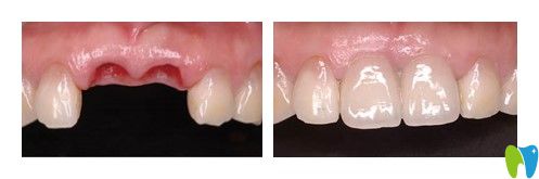 东莞好佰年口腔牛海涛门牙缺失种植案例 东莞好佰年口腔牛海涛门牙缺失种植案例