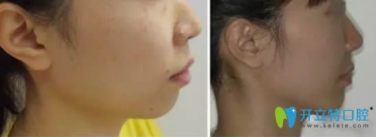 深覆合矫正后脸型变化对比效果图 深覆合矫正后脸型变化对比效果图
