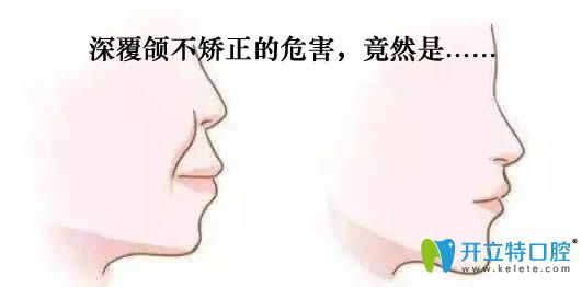 深覆颌不矫正的危害 深覆颌不矫正的危害
