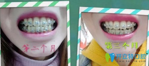 第60天~第90天牙齿已经逐渐排齐 第60天~第90天牙齿已经逐渐排齐