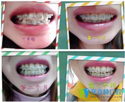牙齿矫正第1天~第90天效果图 牙齿矫正第1天~第90天效果图