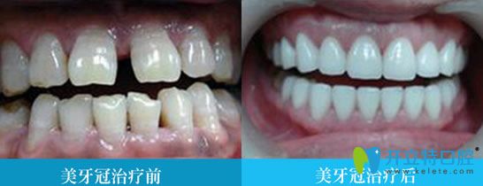 牙齿美容冠修复前后对比图 牙齿美容冠修复前后对比图