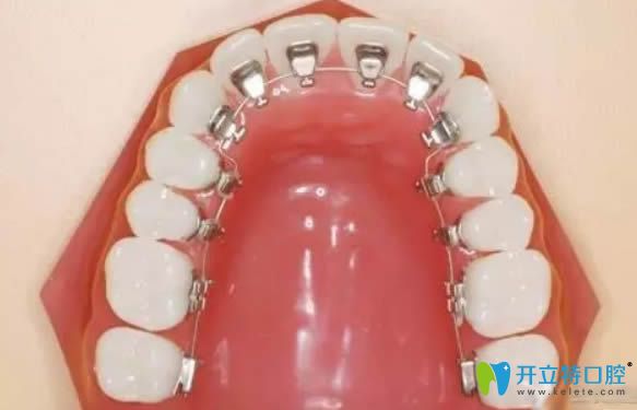 真相!做牙齿矫正选择舌侧矫正和隐适美隐形牙套哪个好？