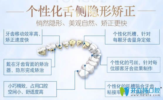 舌侧矫正具有矫正速度快等优势 舌侧矫正具有矫正速度快等优势