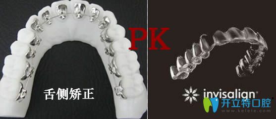 隐适美矫正和舌侧矫正哪个好 隐适美矫正和舌侧矫正哪个好