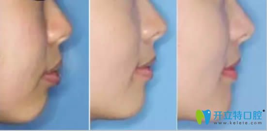 舌侧矫正龅牙案例及脸型变化图
