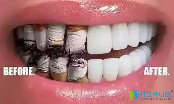抽烟对种植牙的使用寿命有影响吗？