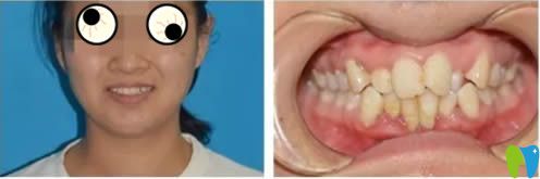 26岁顾客矫正牙齿前的照片