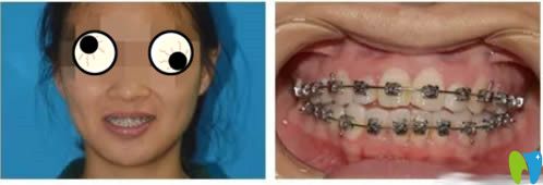 26岁顾客矫正牙齿14个月后的效果